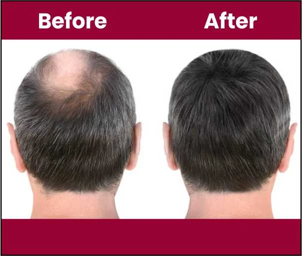 Hair Transplant